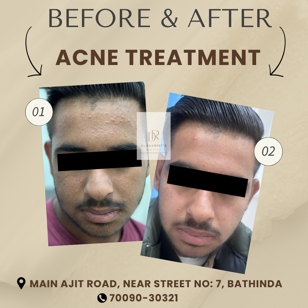 Treatment Result